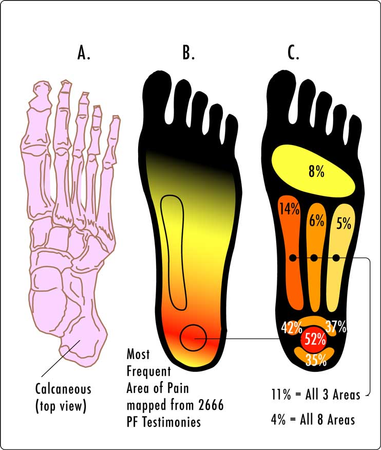 Heel pain. Graphic by Kosi Gramatikoff. GNU Free Documentation License, https://en.wikipedia.org/wiki/en:GNU_Free_Documentation_License