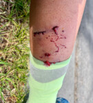 The result of a dog attack while cycling. Photo by Heather Casey