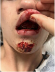 Nickolas Jensen Bike Crash 02 mouth